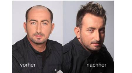 Männer und Haarersatz
